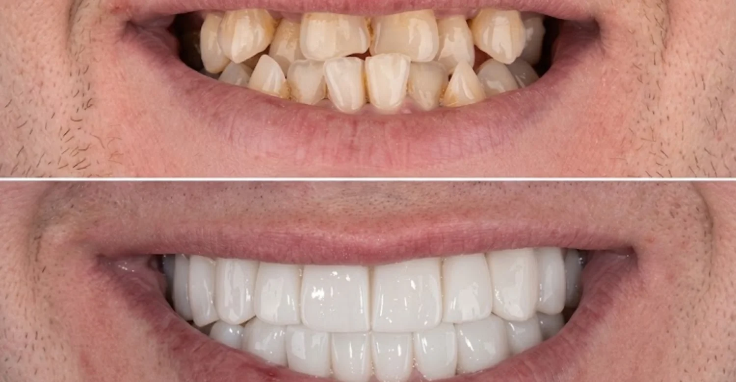 root canal vs filling